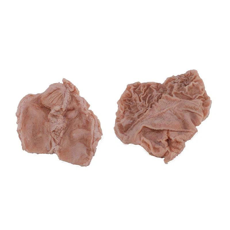 Duodenal Ulcer Model Duodenal Ulcer Model